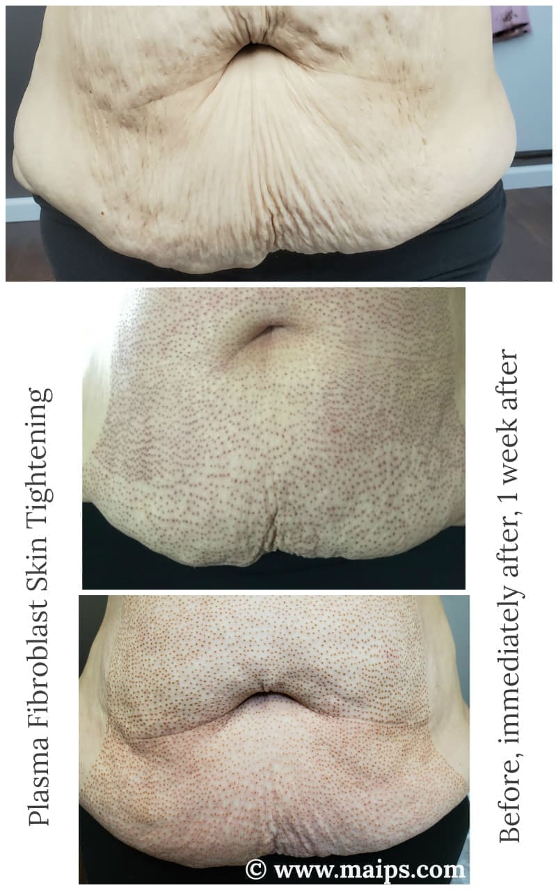 découvrez le rôle essentiel des fibroblastes dans la régénération cellulaire. apprenez comment ces cellules clés contribuent à la guérison des tissus et à la réparation de la peau, et explorez les avancées scientifiques sur leur utilisation en médecine régénérative.