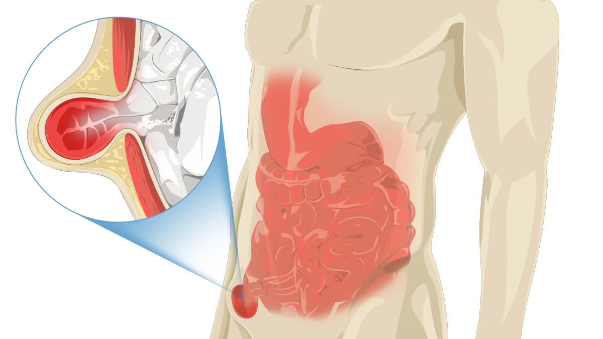 découvrez les causes possibles de la douleur testiculaire accompagnée d'une douleur à la jambe gauche, ainsi que les traitements recommandés pour soulager ces symptômes.